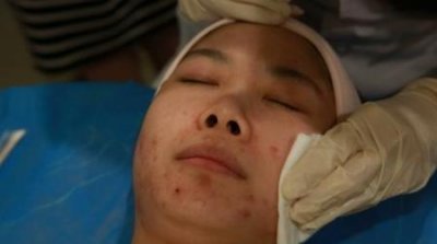 ​刷酸治痘印吗(果酸换肤浓度多少合适)