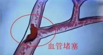 ​血管堵死了能打通吗(脑动脉血管堵塞)