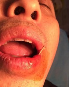 ​被鱼刺卡住了用什么方法(鱼刺卡住喉咙有何妙招)