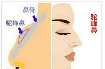 ​驼峰鼻手术风险大不大