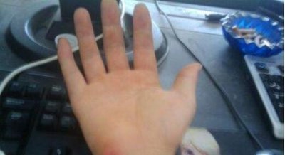 ​鼠标手的症状(什么是鼠标手症状)