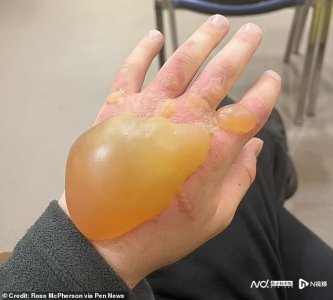 ​英国“最危险的植物”巨型猪笼草，汁液令人的皮肤被阳光烧伤