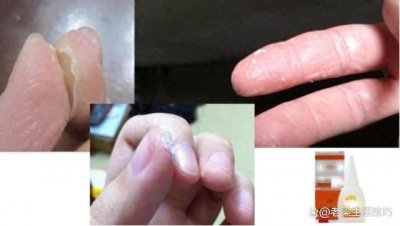 ​502胶粘手上怎么弄掉？别急，学会五种方法，胶水立马融化不伤手